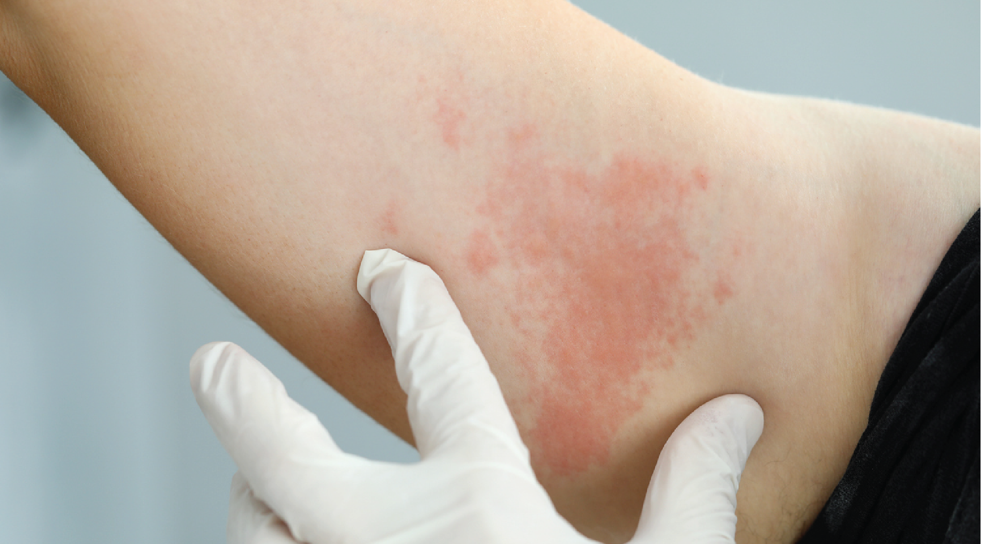 More vulnerable Australians eligible for shingles vaccine 